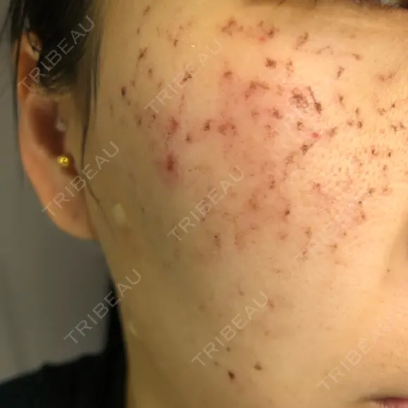 ほくろ・いぼ切除（肌） / 美肌レーザー / シミ取りレーザー / 美白レーザー REYOUNGクリニック DAY 1 メイン用