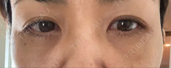 クマ治療 / 下まぶたたるみ取り / 下まぶたの脂肪取り TCB東京中央美容外科 中野院 DAY 9 メイン用