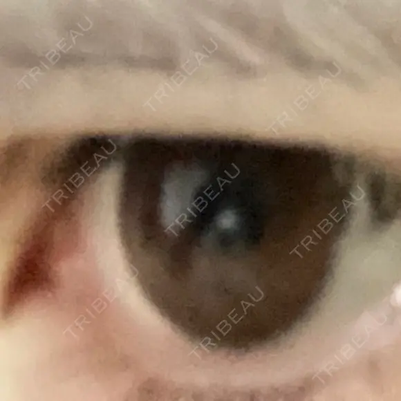 二重切開 牧野皮膚科形成外科内科医院 美容外科・形成外科・抗加齢医学外来 DAY 587 メイン用
