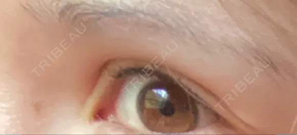 二重切開 牧野皮膚科形成外科内科医院 美容外科・形成外科・抗加齢医学外来 DAY 587 メイン用