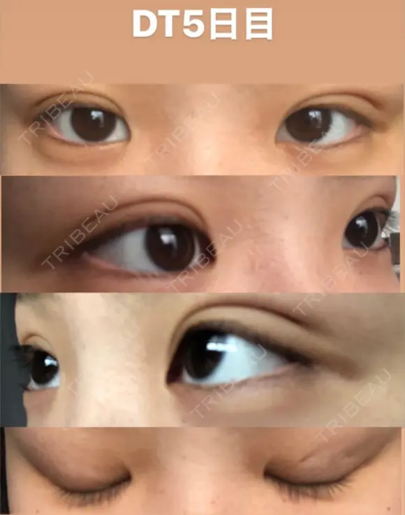 二重埋没 TCB東京中央美容外科 仙台駅前院 DAY 7 メイン用