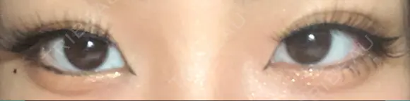 二重埋没 TCB東京中央美容外科 仙台駅前院 DAY 33 メイン用