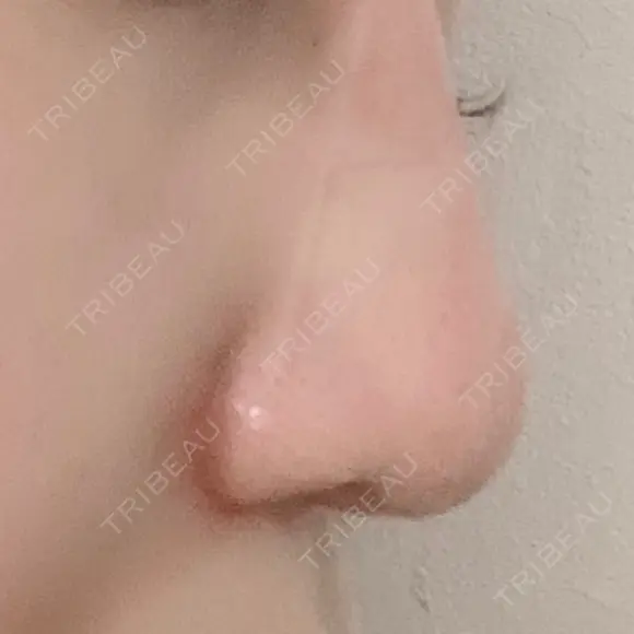 鼻尖形成（切開） / 小鼻縮小（切開） / 鼻孔縁挙上 銀座TAクリニック DAY 62 メイン用