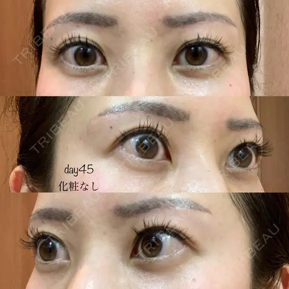 眉下切開 湘南美容クリニック 秋葉原院 DAY 45 メイン用
