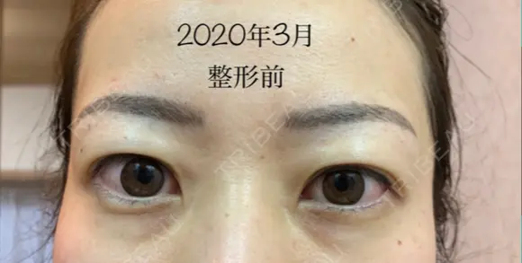 眉下切開 湘南美容クリニック 秋葉原院 DAY 45 メイン用