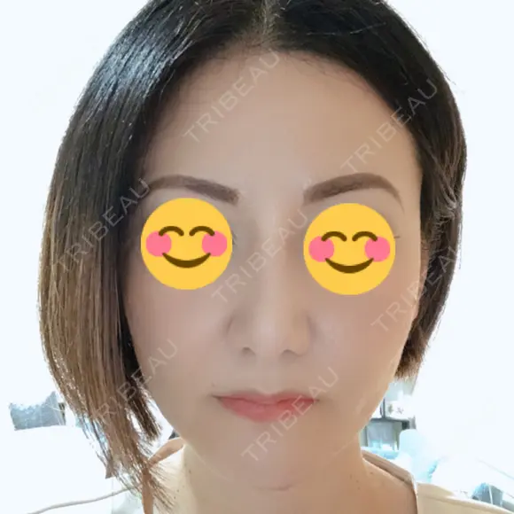 隆鼻術 / 鼻尖形成（切開） / 小鼻縮小（切開） / 軟骨移植 湘南美容クリニック 那覇院 DAY 30 メイン用