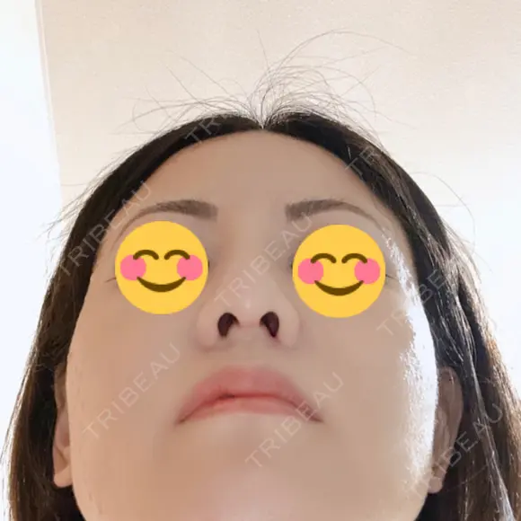 隆鼻術 / 鼻尖形成（切開） / 小鼻縮小（切開） / 軟骨移植 湘南美容クリニック 那覇院 DAY 30 メイン用