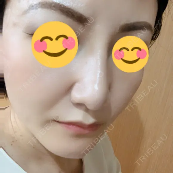 隆鼻術 / 鼻尖形成（切開） / 小鼻縮小（切開） / 軟骨移植 湘南美容クリニック 那覇院 DAY 30 メイン用