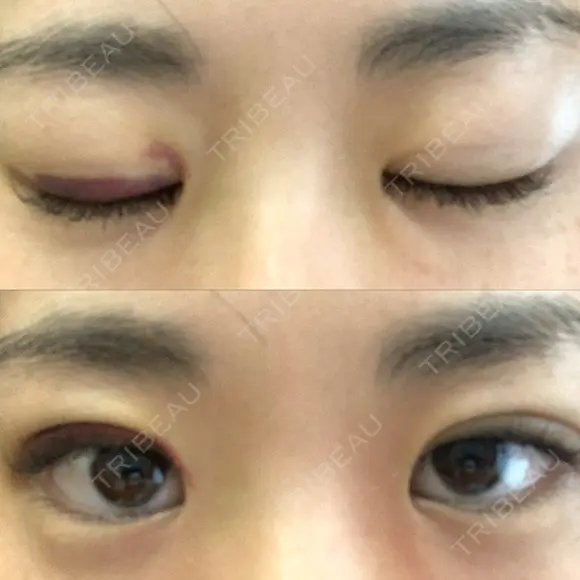 二重埋没 湘南美容クリニック 宇都宮院 AFTER メイン用