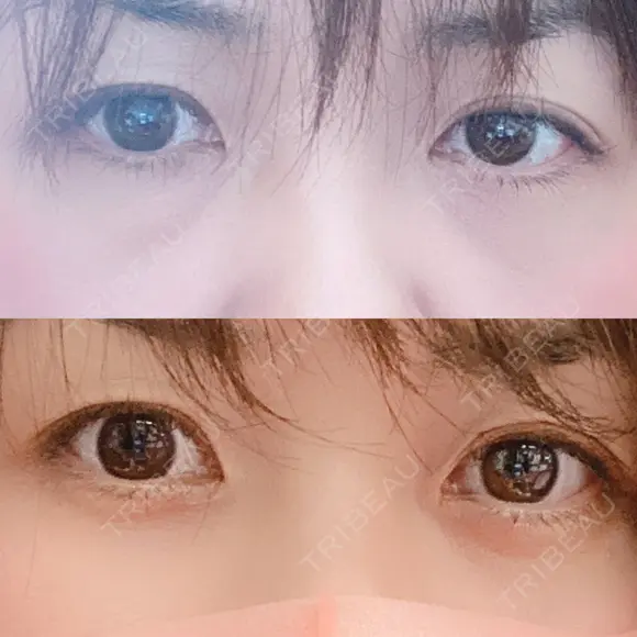 クマ治療 / 下まぶたたるみ取り / 下まぶたの脂肪取り TCB東京中央美容外科 中野院 AFTER メイン用