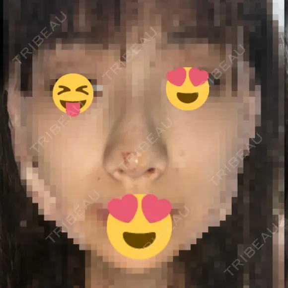 小鼻縮小（切開） / スレッドノーズ / ヒアルロン酸注入（鼻） キップン整形外科 DAY 0 メイン用