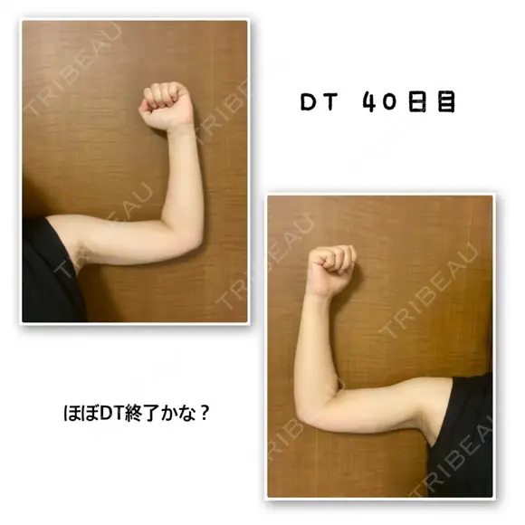 脂肪吸引（二の腕） Mods Clinic（モッズクリニック） 東京院 DAY 40 メイン用