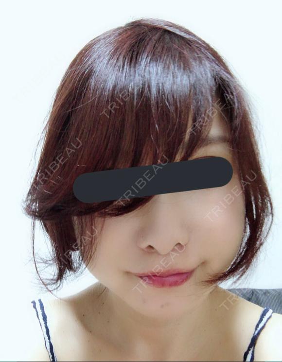 切開リフト GENIUS(ジーニアス)美容外科・皮膚科（旧：4ever美容外科・皮膚科 釜山 西面店） DAY 40 メイン用