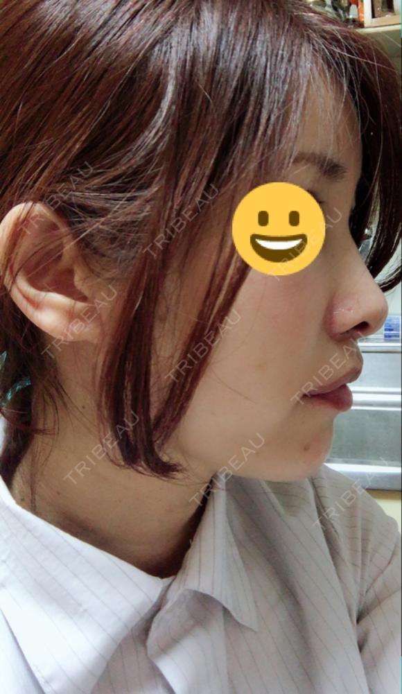 切開リフト GENIUS(ジーニアス)美容外科・皮膚科（旧：4ever美容外科・皮膚科 釜山 西面店） DAY 40 メイン用