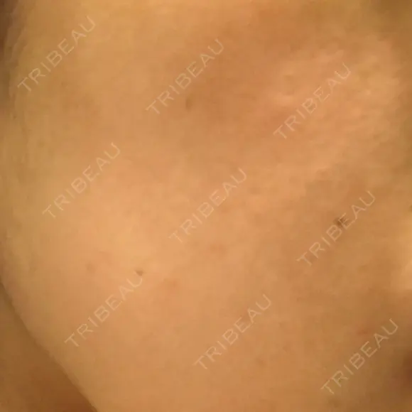 ピーリング（ニキビ・毛穴） 自由が丘クリニック DAY 3 メイン用