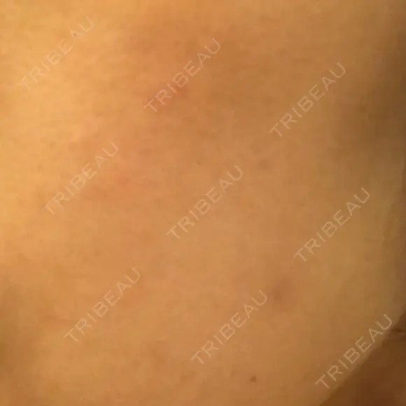 ピーリング（ニキビ・毛穴） 自由が丘クリニック DAY 3 メイン用