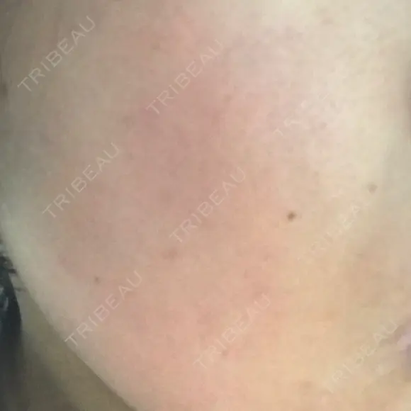 ピーリング（ニキビ・毛穴） 自由が丘クリニック DAY 6 メイン用