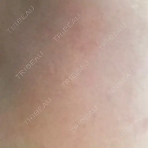 ピーリング（ニキビ・毛穴） 自由が丘クリニック DAY 6 メイン用