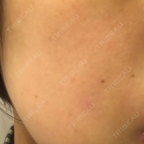 ピーリング（ニキビ・毛穴） 自由が丘クリニック DAY 27 メイン用