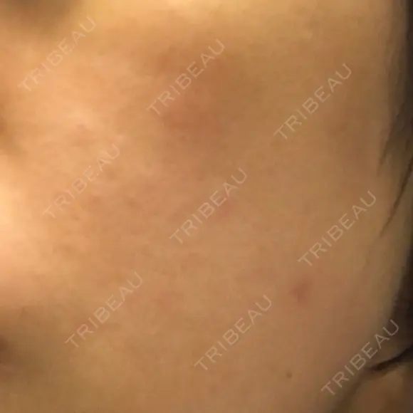 ピーリング（ニキビ・毛穴） 自由が丘クリニック DAY 27 メイン用