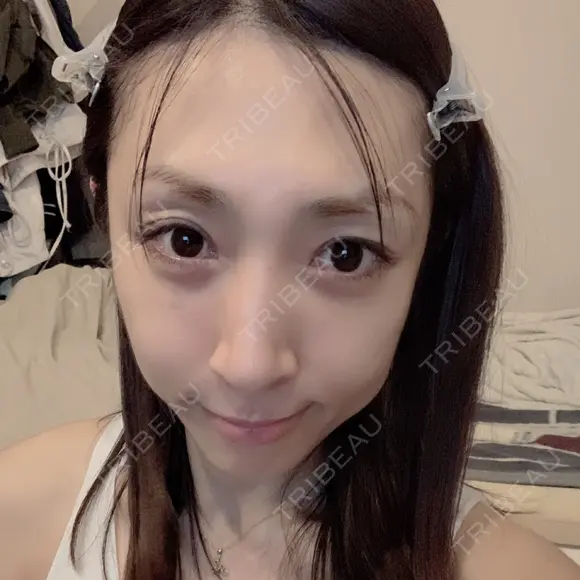 骨切り（あご） / 骨削り（エラ） / 骨削り（頬） / 脂肪注入（輪郭） バノバギ整形外科 DAY 182 メイン用