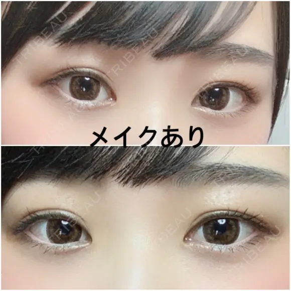 二重切開 / 上まぶたたるみ取り 広島プルミエクリニック DAY 76 メイン用