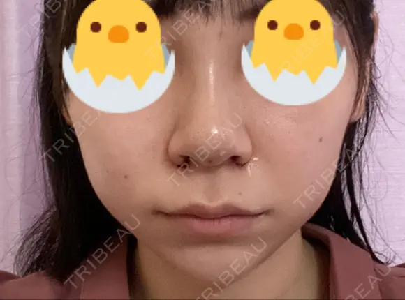 鼻尖形成（切開） / 小鼻縮小（切開） / ヒアルロン酸注入（あご） / ボトックス（エラ・小顔） / ヒアルロン酸注入（唇） / 毛穴洗浄（ハイドラフェイシャルなど） / その他（鼻） TCB東京中央美容外科 横浜院 DAY 1 メイン用