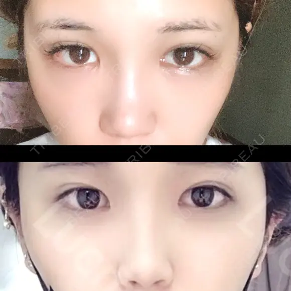 二重埋没 / 目頭切開 / 目尻切開 RG整形外科（旧リオン整形外科） AFTER メイン用