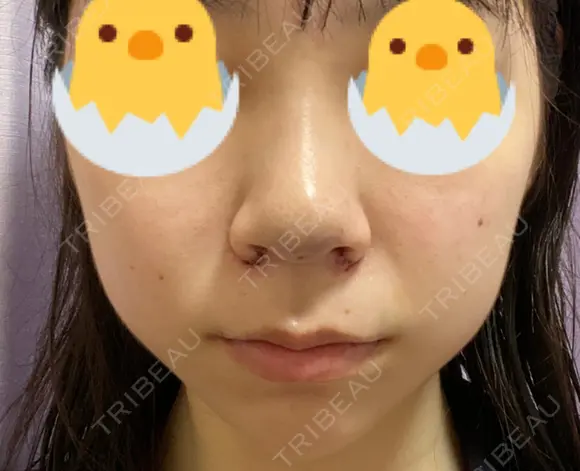 鼻尖形成（切開） / 小鼻縮小（切開） / ヒアルロン酸注入（あご） / ボトックス（エラ・小顔） / ヒアルロン酸注入（唇） / 毛穴洗浄（ハイドラフェイシャルなど） / その他（鼻） TCB東京中央美容外科 横浜院 DAY 2 メイン用