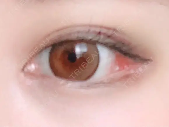 目頭切開 / 目尻切開 FROM B整形外科 (旧バウム整形外科) DAY 13 メイン用