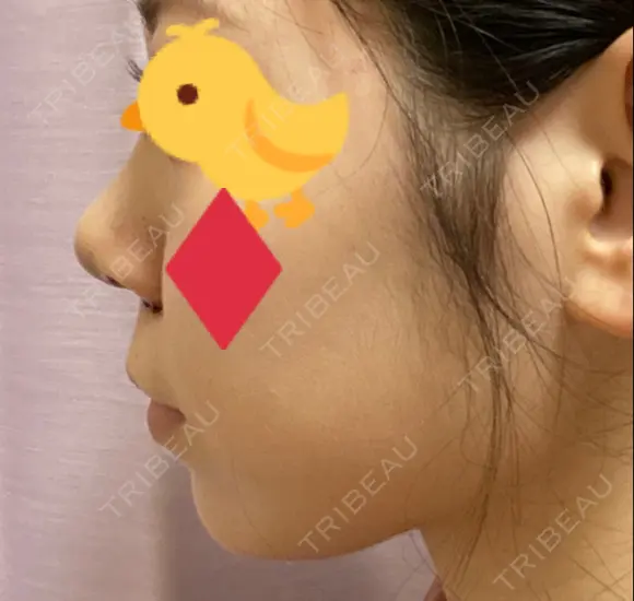 鼻尖形成（切開） / 小鼻縮小（切開） / ヒアルロン酸注入（あご） / ボトックス（エラ・小顔） / ヒアルロン酸注入（唇） / 毛穴洗浄（ハイドラフェイシャルなど） / その他（鼻） TCB東京中央美容外科 横浜院 DAY 3 メイン用