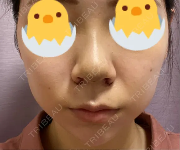 鼻尖形成（切開） / 小鼻縮小（切開） / ヒアルロン酸注入（あご） / ボトックス（エラ・小顔） / ヒアルロン酸注入（唇） / 毛穴洗浄（ハイドラフェイシャルなど） / その他（鼻） TCB東京中央美容外科 横浜院 DAY 3 メイン用