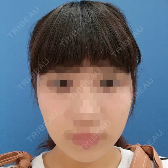 ボトックス（エラ・小顔） 湘南美容クリニック 静岡院 DAY 14 メイン用