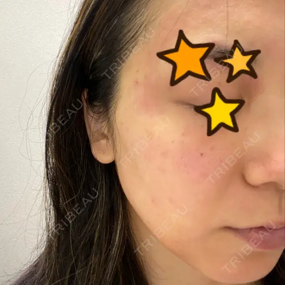 ピーリング（ニキビ・毛穴） / 美肌レーザー / フラクショナルレーザー（毛穴・ニキビ跡） PICO BEAUTY CLINIC DAY 0 メイン用