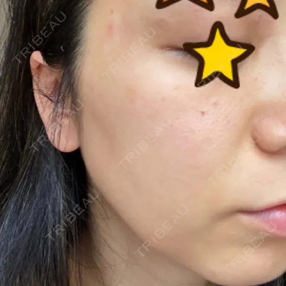 ピーリング（ニキビ・毛穴） / 美肌レーザー / フラクショナルレーザー（毛穴・ニキビ跡） PICO BEAUTY CLINIC DAY 1 メイン用