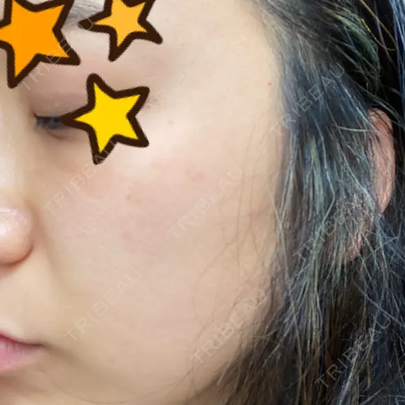 ピーリング（ニキビ・毛穴） / 美肌レーザー / フラクショナルレーザー（毛穴・ニキビ跡） PICO BEAUTY CLINIC DAY 1 メイン用