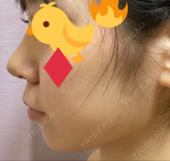 鼻尖形成（切開） / 小鼻縮小（切開） / ヒアルロン酸注入（あご） / ボトックス（エラ・小顔） / ヒアルロン酸注入（唇） / 毛穴洗浄（ハイドラフェイシャルなど） / その他（鼻） TCB東京中央美容外科 横浜院 AFTER メイン用