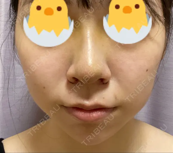 鼻尖形成（切開） / 小鼻縮小（切開） / ヒアルロン酸注入（あご） / ボトックス（エラ・小顔） / ヒアルロン酸注入（唇） / 毛穴洗浄（ハイドラフェイシャルなど） / その他（鼻） TCB東京中央美容外科 横浜院 DAY 5 メイン用