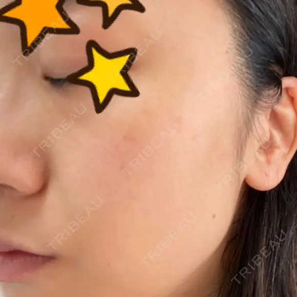 ピーリング（ニキビ・毛穴） / 美肌レーザー / フラクショナルレーザー（毛穴・ニキビ跡） PICO BEAUTY CLINIC DAY 2 メイン用