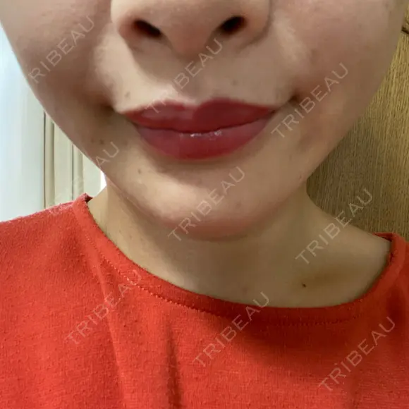 アートメイク（唇） BMC CLINIC 南青山 DAY 1 メイン用