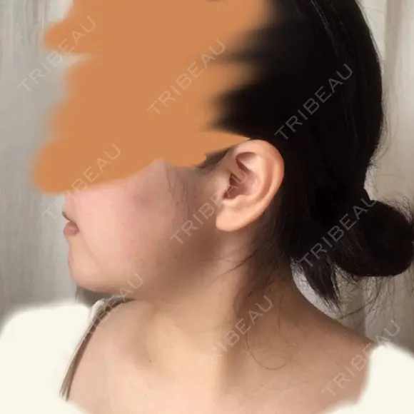 骨切り（あご） ボンディ美容整形外科（旧リオン整形外科） DAY 181 メイン用