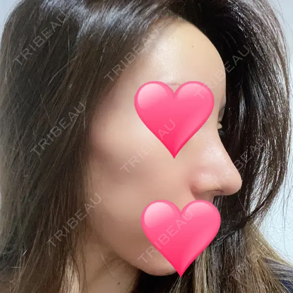 鼻中隔延長（切開） / 骨切幅寄せ / ワシ鼻修正・ハンプ切除 表参道スキンクリニック 表参道院 DAY 29 メイン用