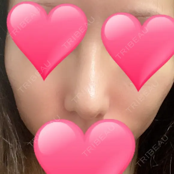 鼻中隔延長（切開） / 骨切幅寄せ / ワシ鼻修正・ハンプ切除 表参道スキンクリニック 表参道院 DAY 29 メイン用