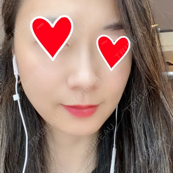 ピーリング（ニキビ・毛穴） / 美肌レーザー / フラクショナルレーザー（毛穴・ニキビ跡） PICO BEAUTY CLINIC DAY 4 メイン用