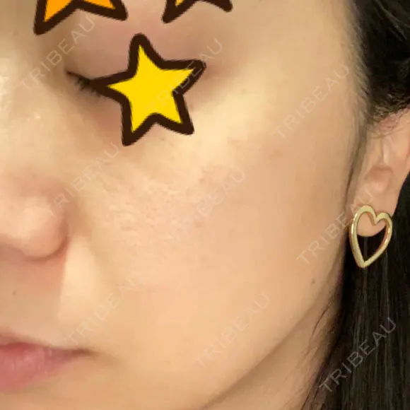 ピーリング（ニキビ・毛穴） / 美肌レーザー / フラクショナルレーザー（毛穴・ニキビ跡） PICO BEAUTY CLINIC DAY 4 メイン用