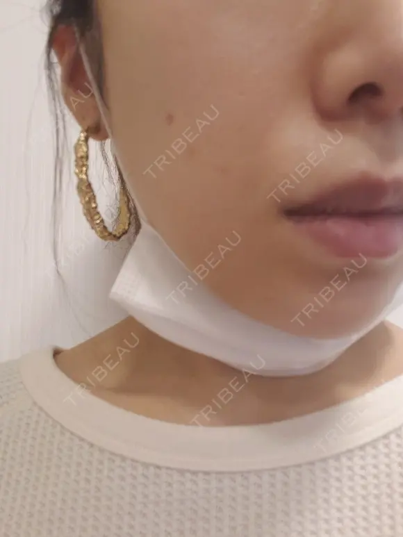 ニキビ治療 品川美容外科 仙台院 DAY 0 メイン用