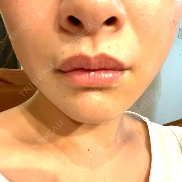 アートメイク（唇） BMC CLINIC 南青山 DAY 2 メイン用