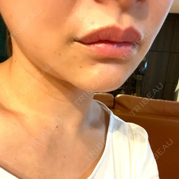 アートメイク（唇） BMC CLINIC 南青山 DAY 2 メイン用