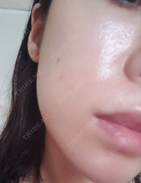 ニキビ治療 品川美容外科 仙台院 DAY 1 メイン用