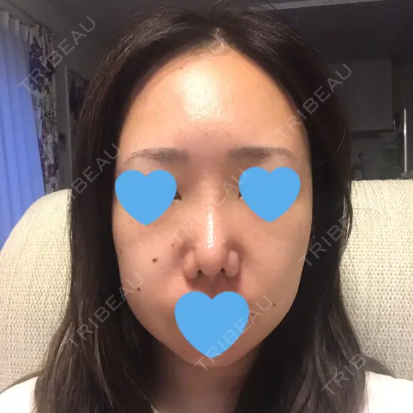 鼻尖形成（切開） / 軟骨移植 / 眉間プロテーゼ / 鼻尖縮小 湘南美容クリニック 柏院 DAY 25 メイン用